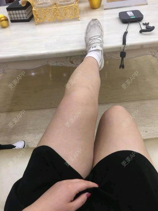 更美 - 更美用户uhjgJzL3xQ的吸脂瘦大腿经验 | 手臂吸脂 | 吸脂 | 吸脂瘦大腿 | 广州