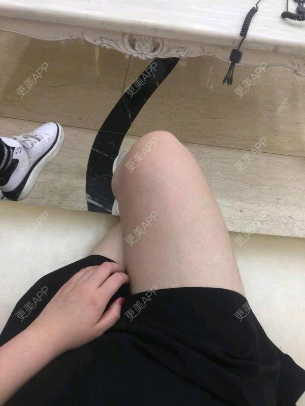 更美 - 更美用户uhjgJzL3xQ的吸脂瘦大腿经验 | 手臂吸脂 | 吸脂 | 吸脂瘦大腿 | 广州