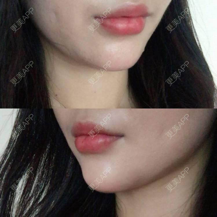 更美 - 陈炳伟 医生的水光项目经验 | 水光项目 | 温州