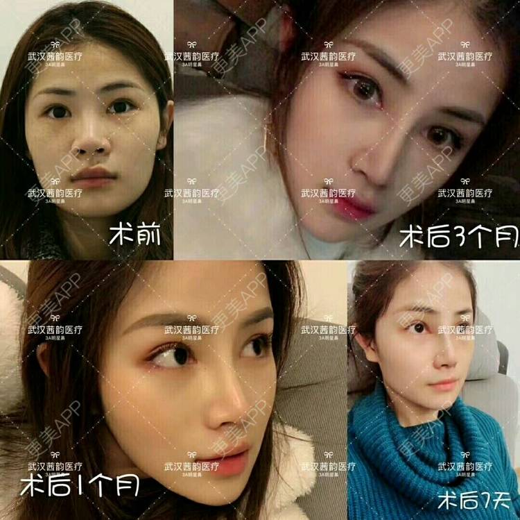 更美 - 更美用户7EKM3eDt53的激光淡斑经验 | 自体脂肪隆胸 | 宁波 | 武汉 | 激光淡斑 | 鼻部多项 | 水光项目 | 深圳