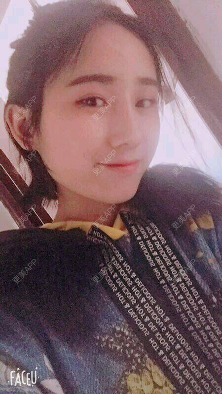 更美 - 萌萌叮当猫的隆鼻经验 | 鼻部膨体假体取出 | 重庆 | 隆鼻 | 鼻形态修复