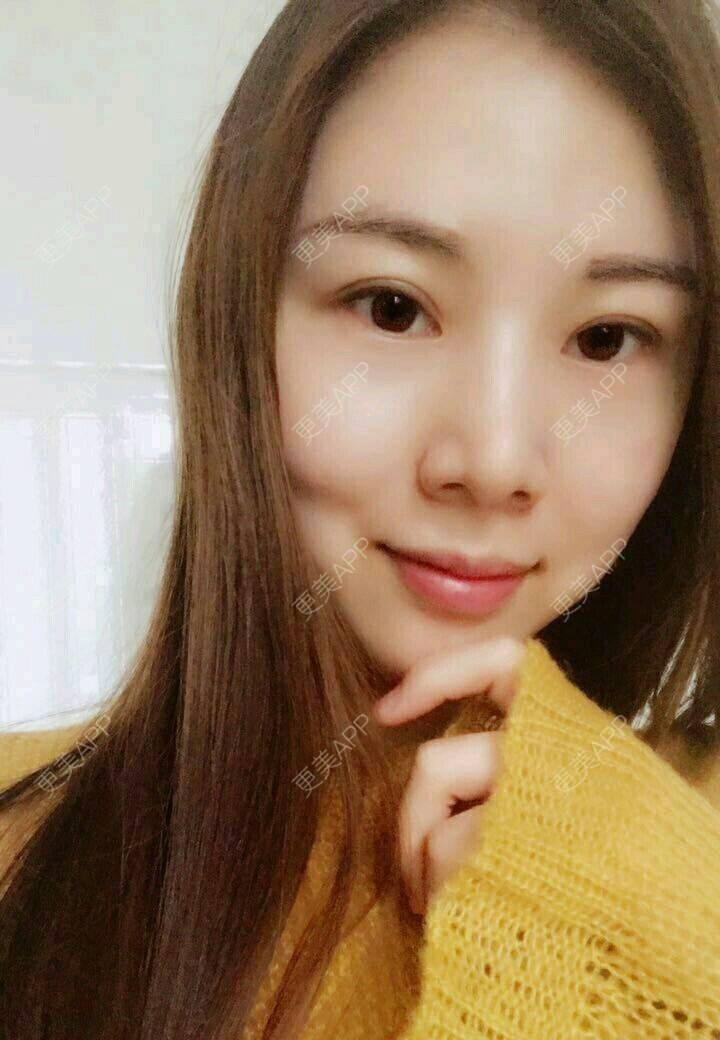 更美 - xNz3B婷的歪鼻矫正经验 | 上海 | 歪鼻矫正