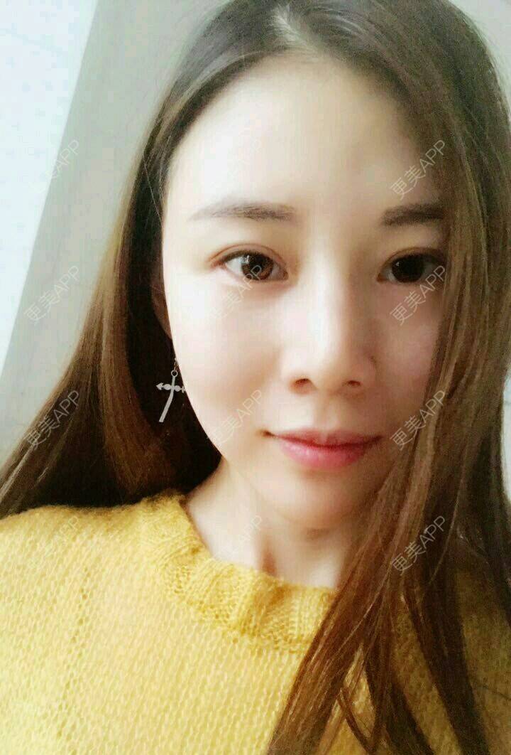 更美 - xNz3B婷的歪鼻矫正经验 | 上海 | 歪鼻矫正