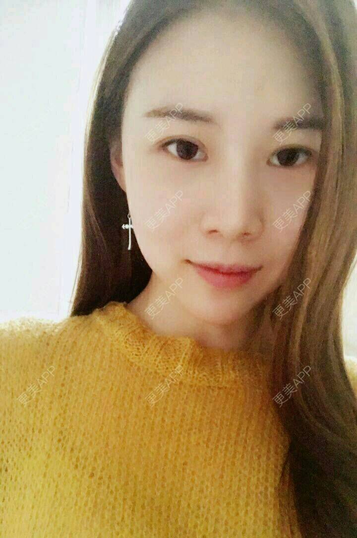更美 - xNz3B婷的歪鼻矫正经验 | 上海 | 歪鼻矫正