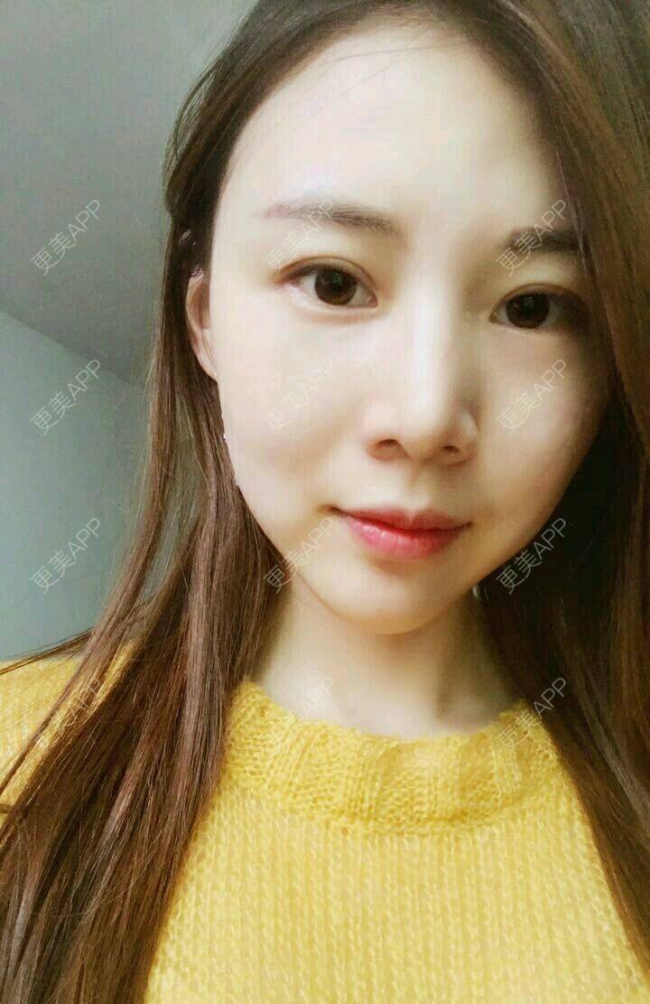 更美 - xNz3B婷的歪鼻矫正经验 | 上海 | 歪鼻矫正