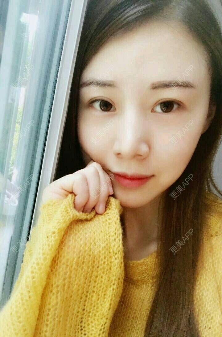 更美 - xNz3B婷的歪鼻矫正经验 | 上海 | 歪鼻矫正
