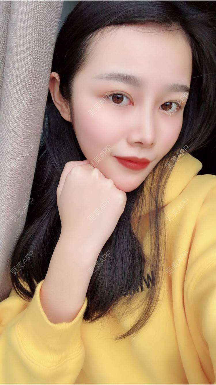 更美 - 鲁噜噜的经验 | 视频日记 | 重庆 | 鼻部膨体假体取出 | 鼻部整形 | 隆鼻手术修复