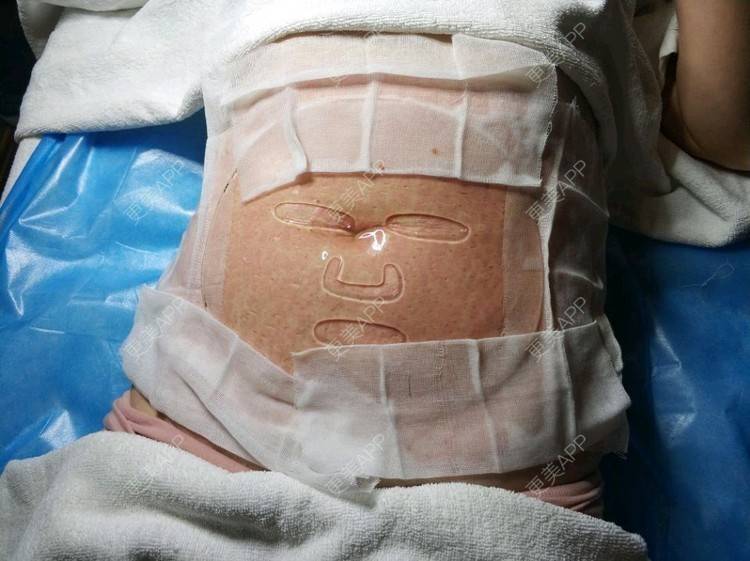 微针淡化妊娠纹手术