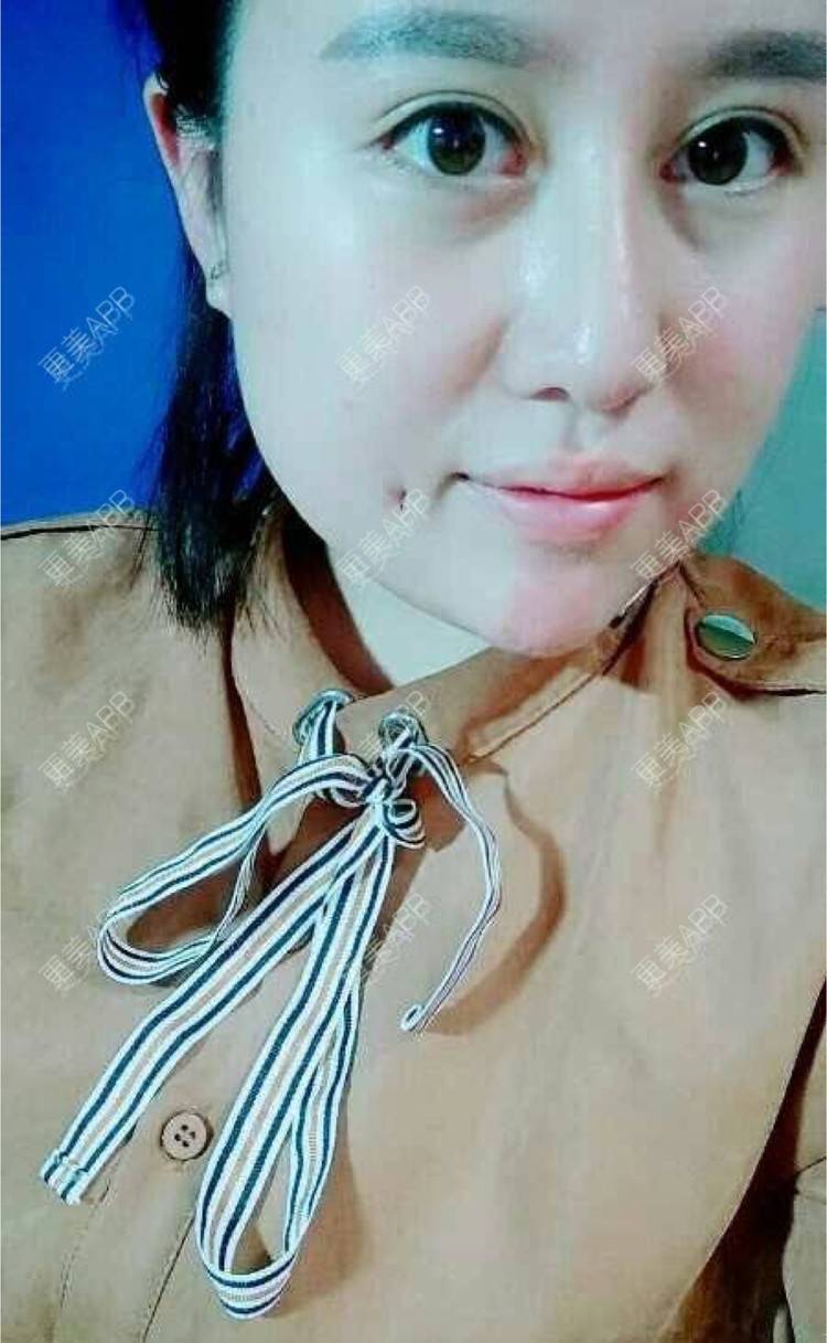 手里旧人的酒窝成形术日记