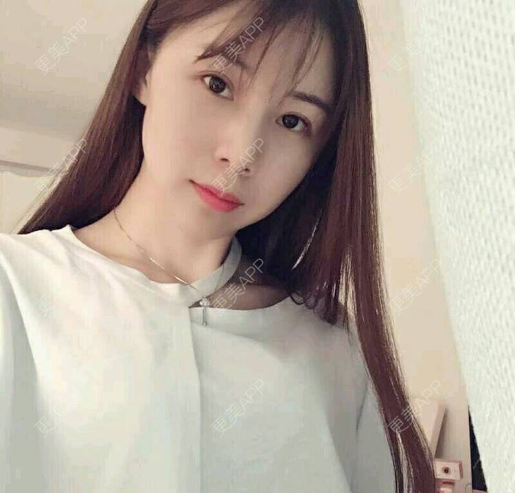 更美 - xNz3B婷的歪鼻矫正经验 | 上海 | 歪鼻矫正