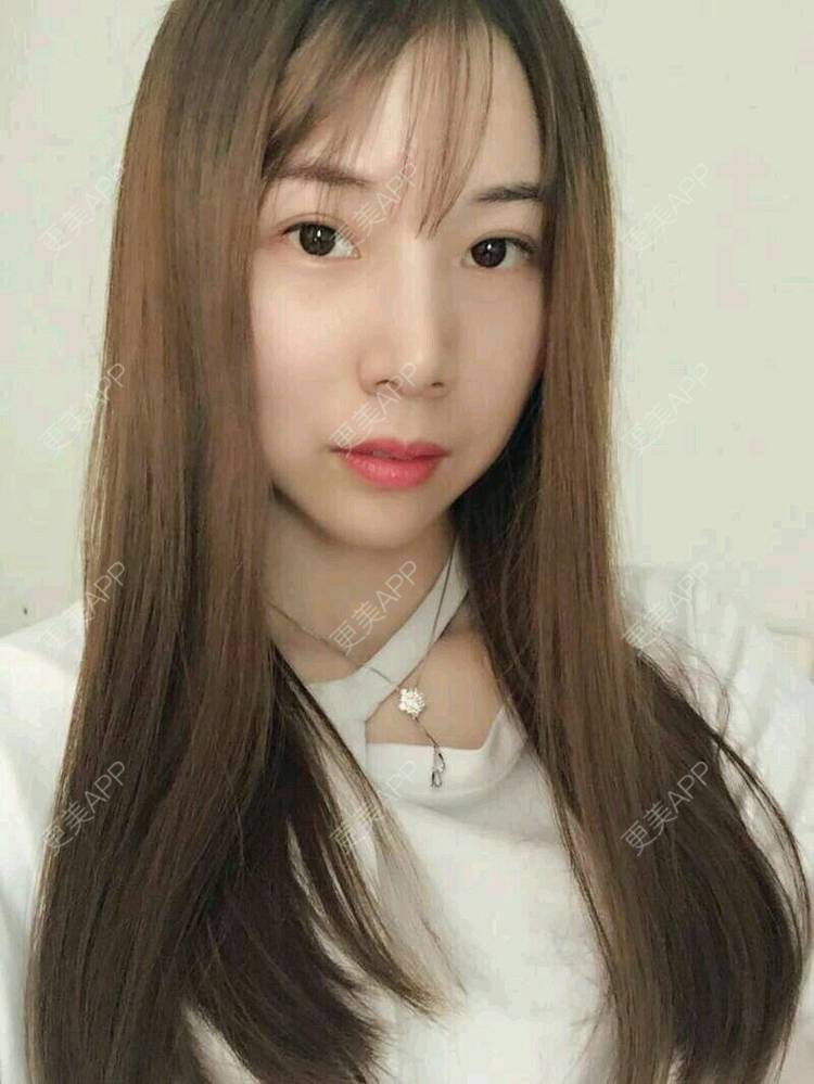 更美 - xNz3B婷的歪鼻矫正经验 | 上海 | 歪鼻矫正