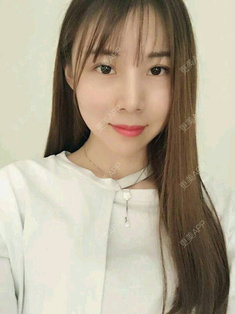 更美 - xNz3B婷的歪鼻矫正经验 | 上海 | 歪鼻矫正