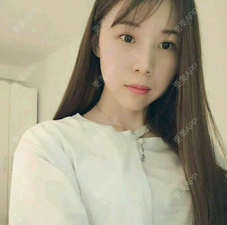 更美 - xNz3B婷的歪鼻矫正经验 | 上海 | 歪鼻矫正