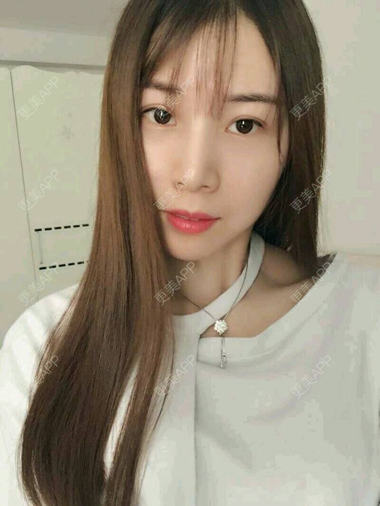更美 - xNz3B婷的歪鼻矫正经验 | 上海 | 歪鼻矫正