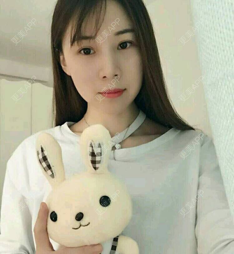 更美 - xNz3B婷的歪鼻矫正经验 | 上海 | 歪鼻矫正