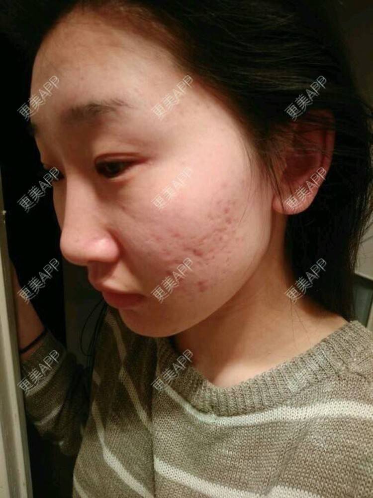 更美用户kvel6drrcr的祛疤痕痘印日记