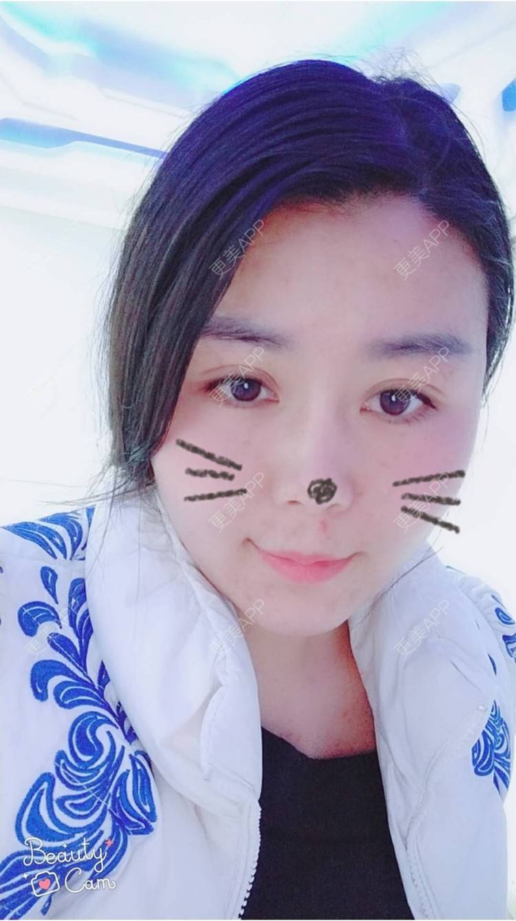 更美 - 更美用户unWeXuJrWw的玻尿酸唇部经验 | 玻尿酸唇部 | 武汉