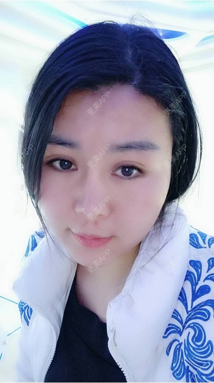 更美 - 更美用户unWeXuJrWw的玻尿酸唇部经验 | 玻尿酸唇部 | 武汉