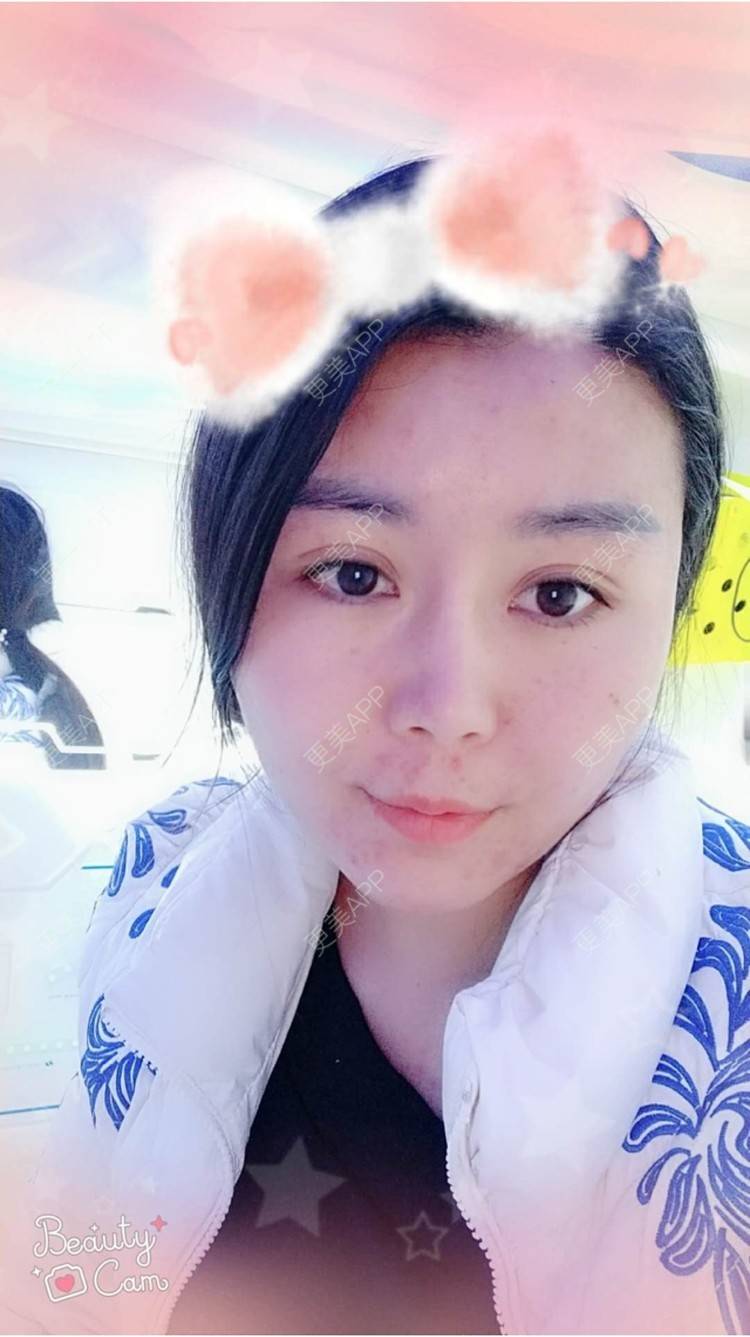 更美 - 更美用户unWeXuJrWw的玻尿酸唇部经验 | 玻尿酸唇部 | 武汉