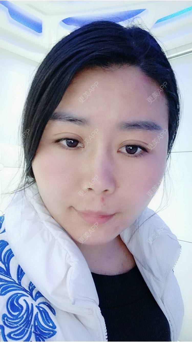 更美 - 更美用户unWeXuJrWw的玻尿酸唇部经验 | 玻尿酸唇部 | 武汉
