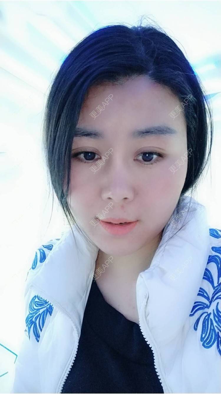 更美 - 更美用户unWeXuJrWw的玻尿酸唇部经验 | 玻尿酸唇部 | 武汉
