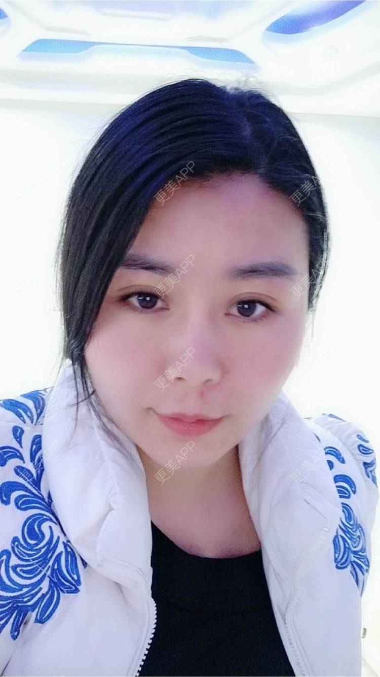 更美 - 更美用户unWeXuJrWw的玻尿酸唇部经验 | 玻尿酸唇部 | 武汉
