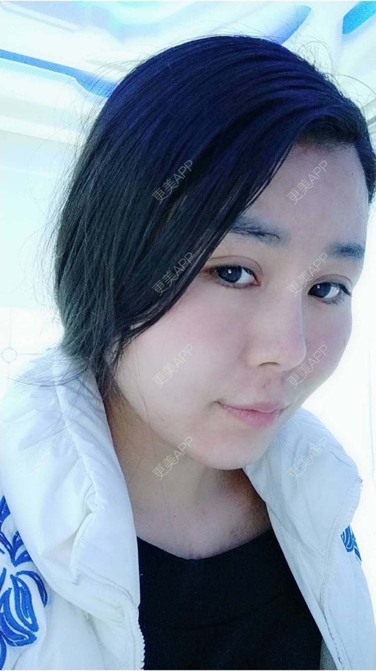 更美 - 更美用户unWeXuJrWw的玻尿酸唇部经验 | 玻尿酸唇部 | 武汉