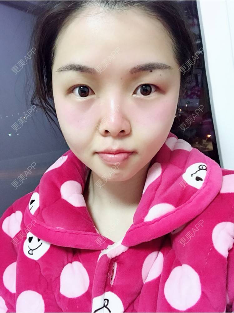 更美 - 顾霏。的植眉经验 | 植眉 | 种植眉毛 | 武汉 | 眉毛种植