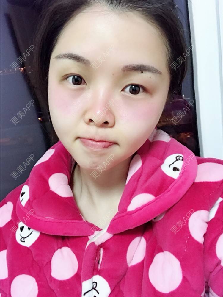 更美 - 顾霏。的植眉经验 | 植眉 | 种植眉毛 | 武汉 | 眉毛种植