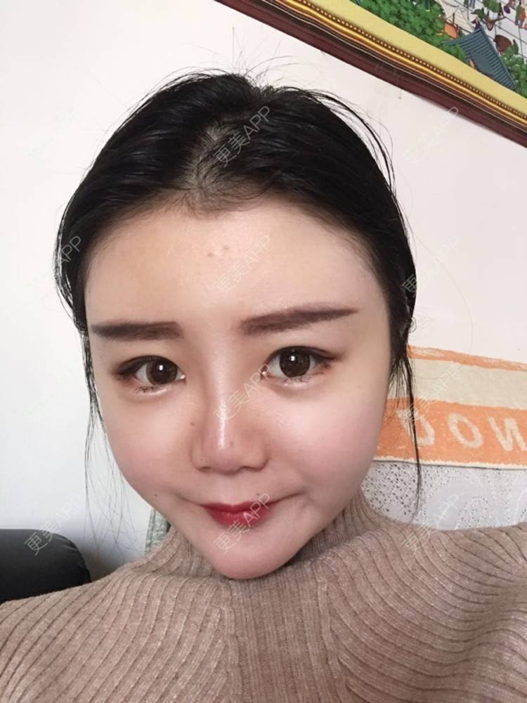 更美 - 静静小可爱的经验 | 纳米自体脂肪面部填充 | 重庆