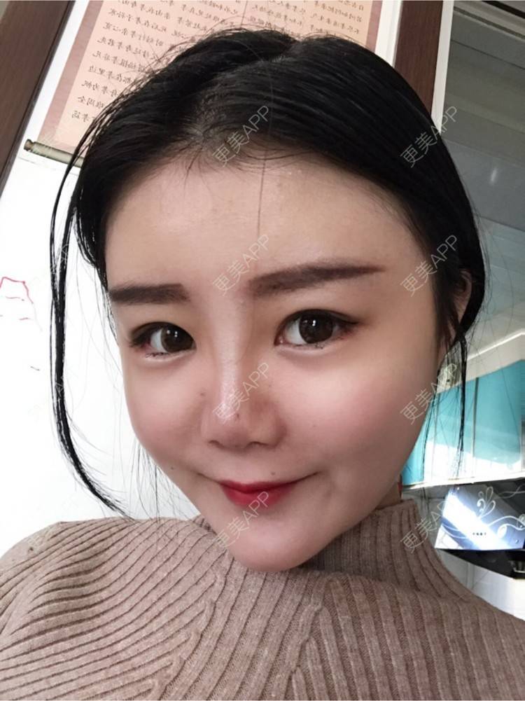 更美 - 静静小可爱的经验 | 纳米自体脂肪面部填充 | 重庆