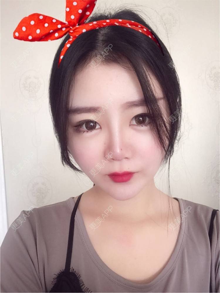 更美 - 静静小可爱的经验 | 纳米自体脂肪面部填充 | 重庆