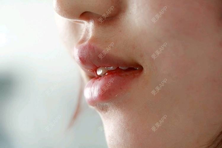 更美 - 唐晓伊的玻尿酸唇部经验 | 玻尿酸唇部 | 北京