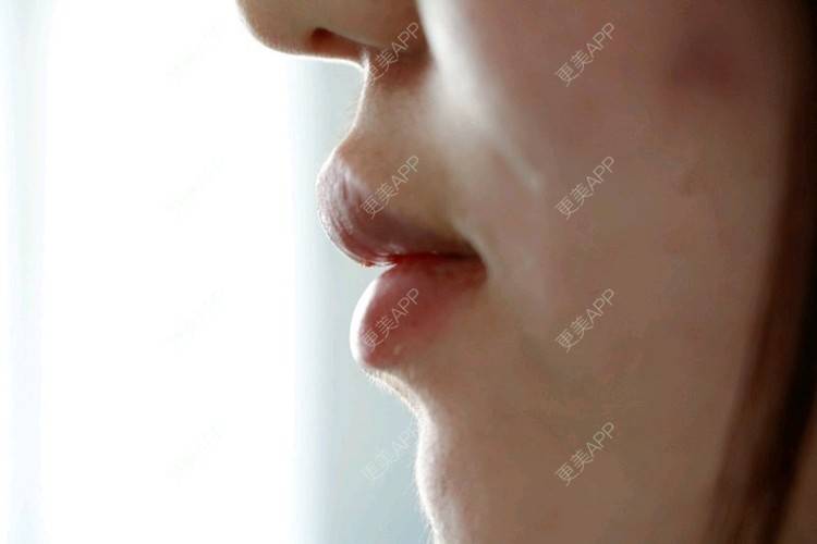更美 - 唐晓伊的玻尿酸唇部经验 | 玻尿酸唇部 | 北京