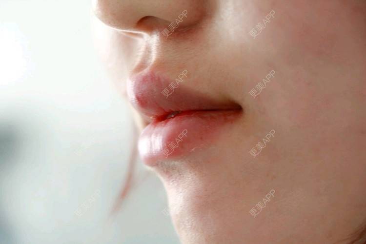 更美 - 唐晓伊的玻尿酸唇部经验 | 玻尿酸唇部 | 北京