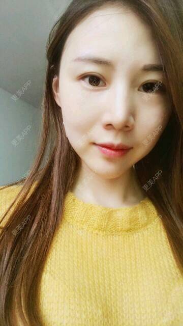 更美 - xNz3B婷的歪鼻矫正经验 | 上海 | 歪鼻矫正