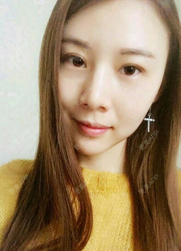 更美 - xNz3B婷的歪鼻矫正经验 | 上海 | 歪鼻矫正
