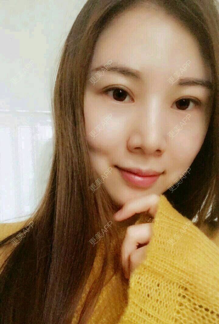 更美 - xNz3B婷的歪鼻矫正经验 | 上海 | 歪鼻矫正