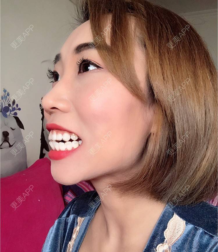 隐形牙齿矫正效果图_我是大晨儿_术后94天__更美