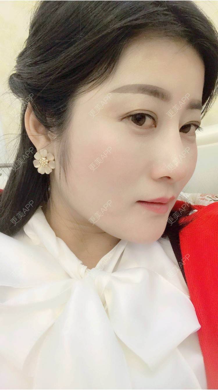 更美 - 安逸悠然的膨体隆鼻经验 | 膨体隆鼻 | 假体隆鼻 | 鼻头鼻翼 | 武汉