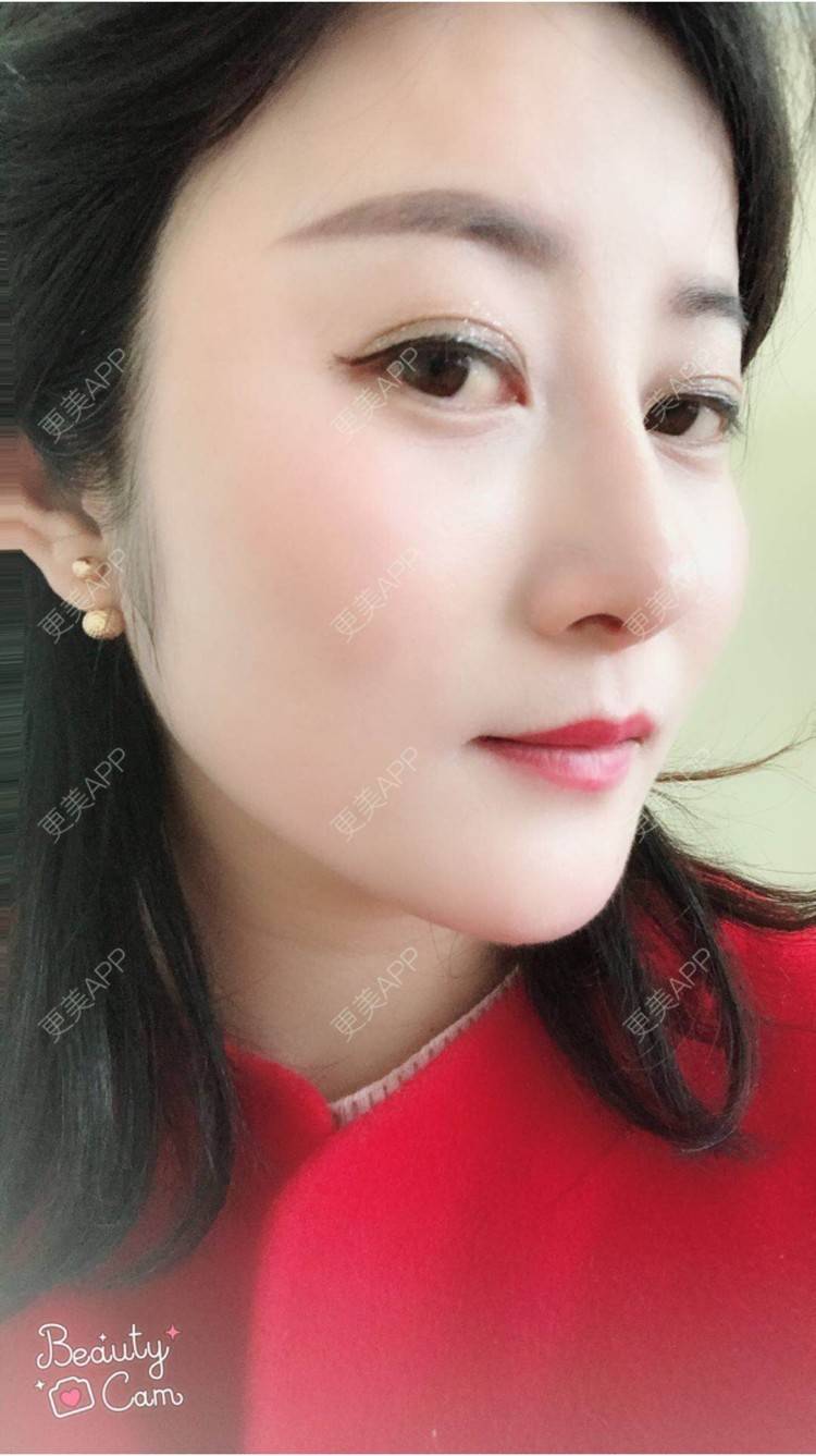 更美 - 安逸悠然的膨体隆鼻经验 | 膨体隆鼻 | 假体隆鼻 | 鼻头鼻翼 | 武汉