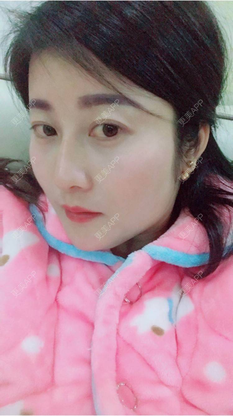 更美 - 安逸悠然的膨体隆鼻经验 | 膨体隆鼻 | 假体隆鼻 | 鼻头鼻翼 | 武汉