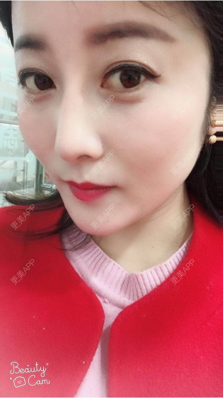 更美 - 安逸悠然的膨体隆鼻经验 | 膨体隆鼻 | 假体隆鼻 | 鼻头鼻翼 | 武汉