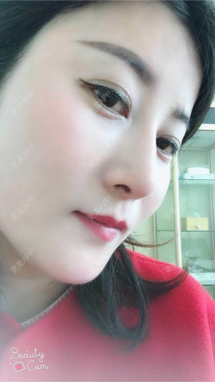 更美 - 安逸悠然的膨体隆鼻经验 | 膨体隆鼻 | 假体隆鼻 | 鼻头鼻翼 | 武汉