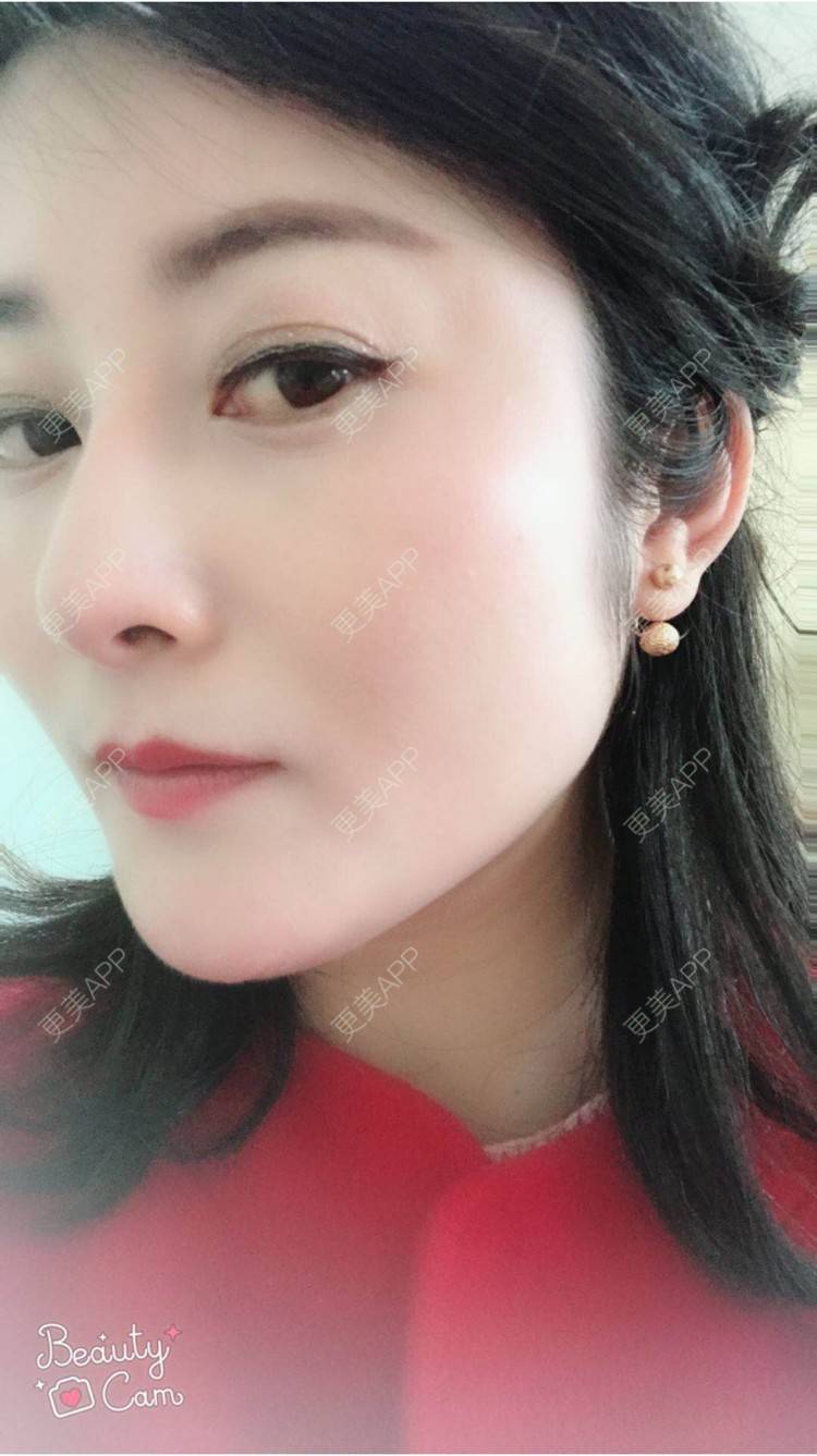 更美 - 安逸悠然的膨体隆鼻经验 | 膨体隆鼻 | 假体隆鼻 | 鼻头鼻翼 | 武汉