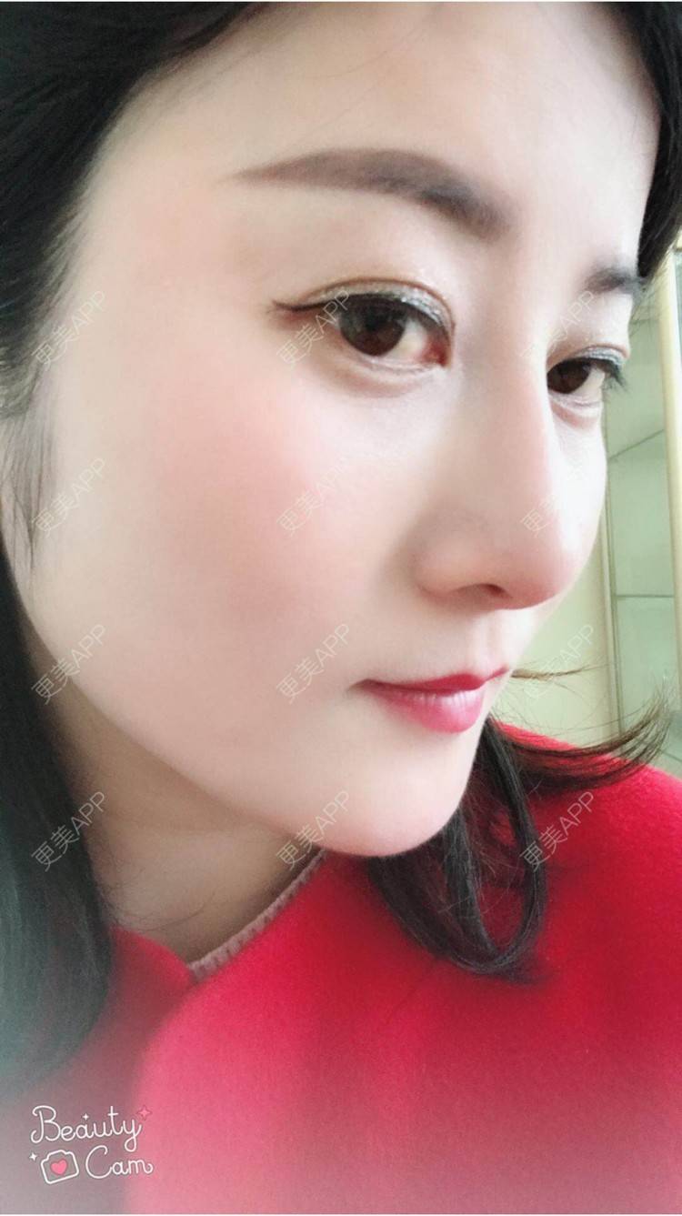 更美 - 安逸悠然的膨体隆鼻经验 | 膨体隆鼻 | 假体隆鼻 | 鼻头鼻翼 | 武汉