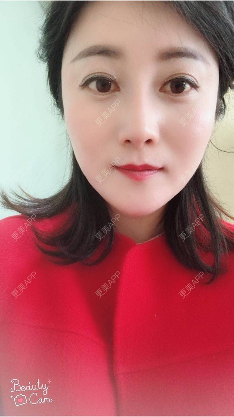 更美 - 安逸悠然的膨体隆鼻经验 | 膨体隆鼻 | 假体隆鼻 | 鼻头鼻翼 | 武汉