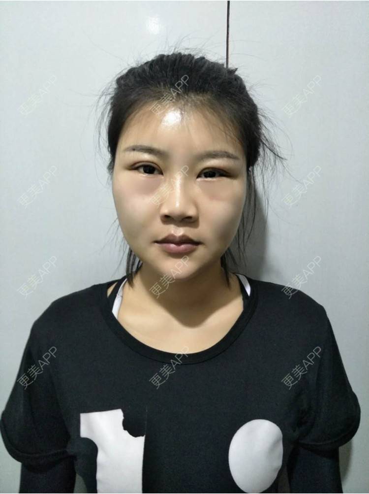 更美 - bug女的经验 | 纳米自体脂肪面部填充 | 重庆
