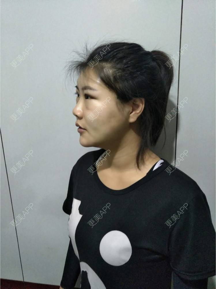 更美 - bug女的经验 | 纳米自体脂肪面部填充 | 重庆