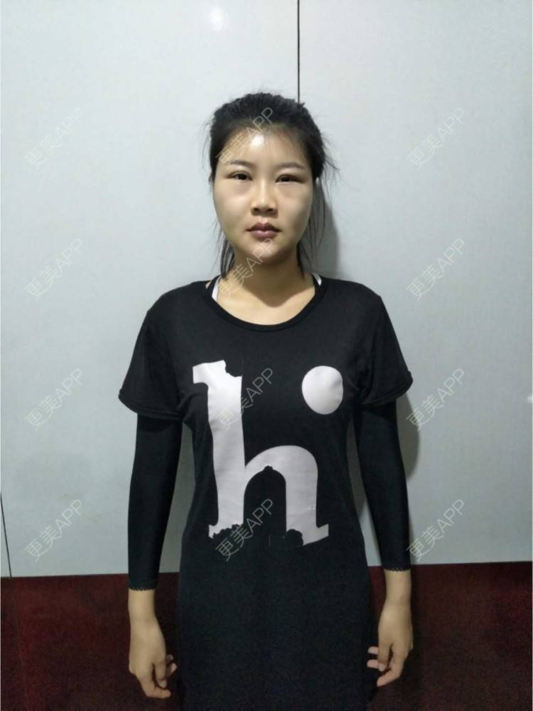 更美 - bug女的经验 | 纳米自体脂肪面部填充 | 重庆